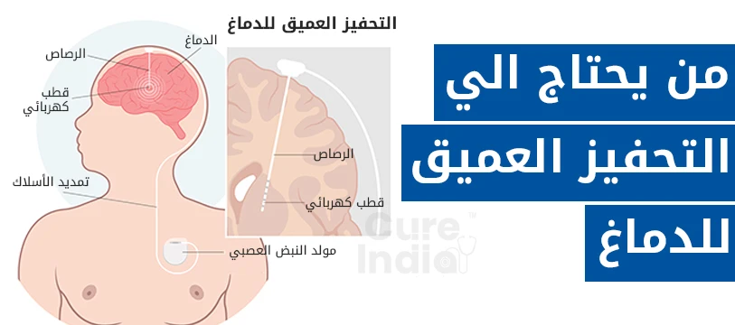 علاج التحفيز العميق للدماغ في الهند